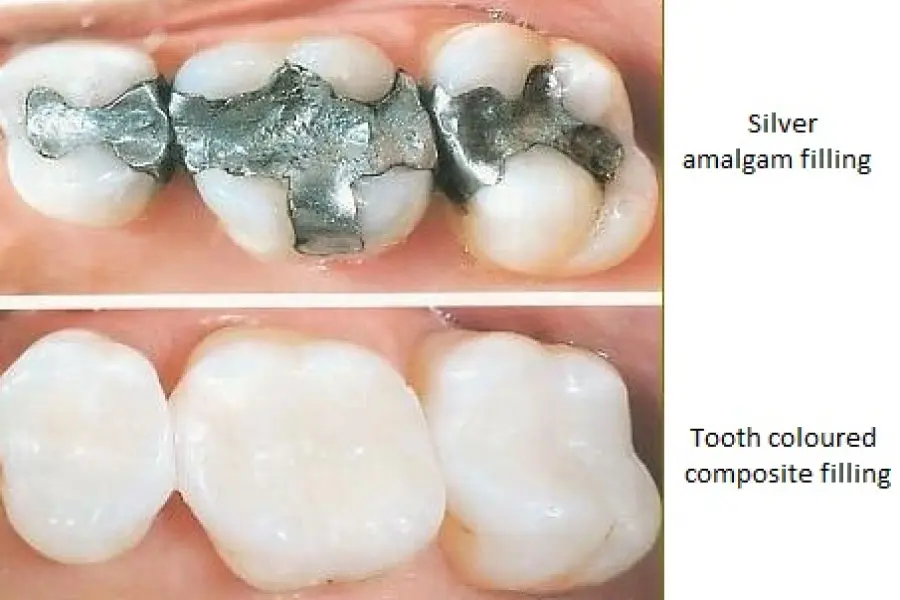 Tooth Filling at Kranti Dental Care in Aurangabad