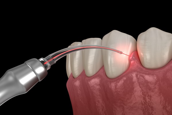 Dental Laser Treatment at Kranti Dental Care in Aurangabad