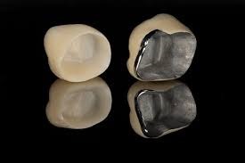 Dental Crown Treatment at Kranti Dental Care in Aurangabad