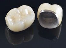 Metal Ceramic Dental Crown at Kranti Dental Care in Aurangabad
