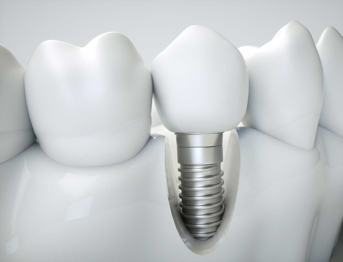 Best Implantologist at Kranti Dental Care in Aurangabad