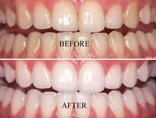 Teeth Whitening Before and After at Kranti Dental Care in Aurangabad